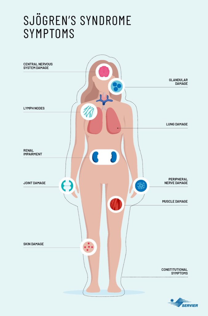 Infographic on the symptoms of Sjögren's syndrome