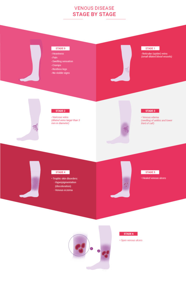 Infographic on the symptoms of venous diseases