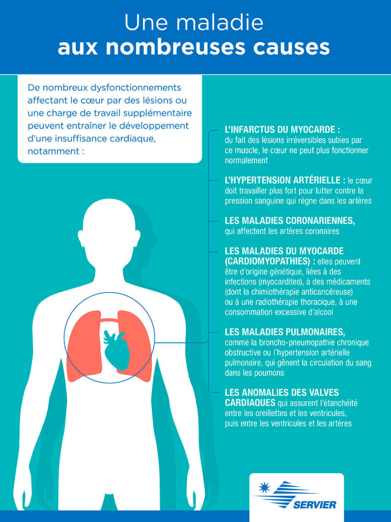 Infographie sur les causes de l'insuffisance cardiaque