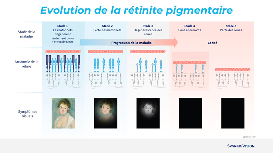 Description de la perte de vue lors d'une rétinite pigmentaire