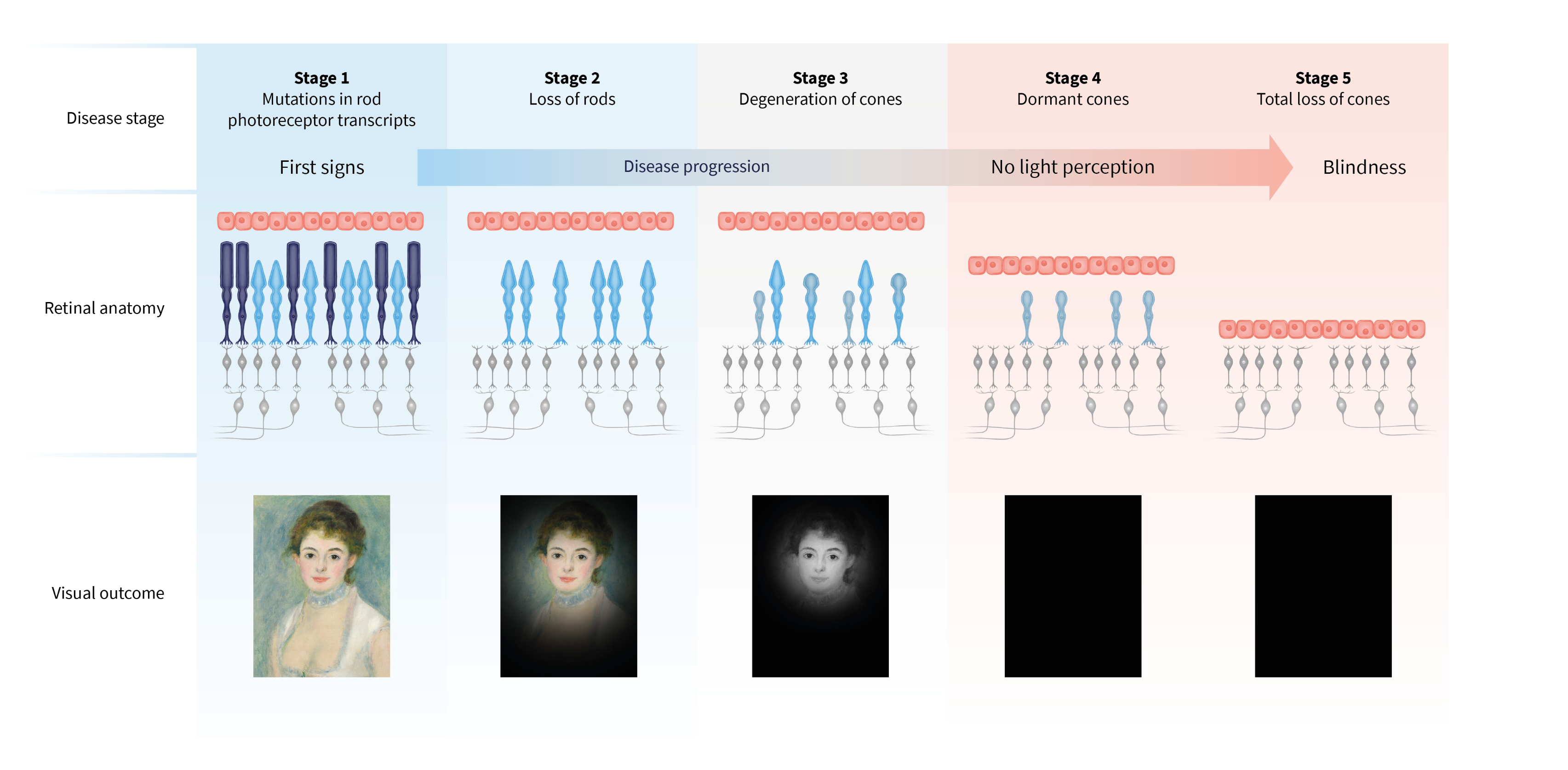 Description of vision loss in retinitis pigmentosa